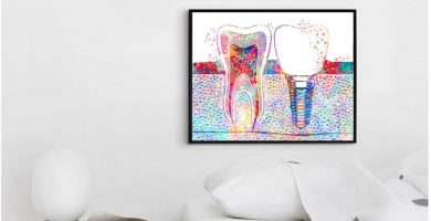 cuadro de dientes e implantes